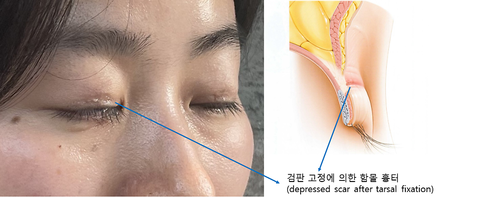 쌍꺼풀 함몰흉터를 교정하는 재수술 관련 이미지 2