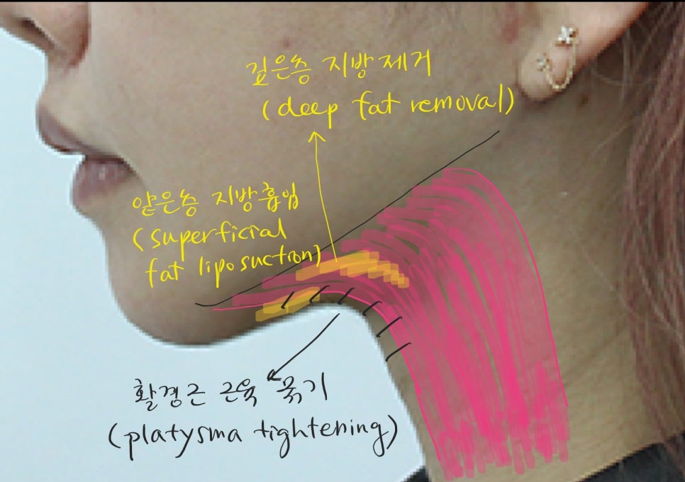 Submental Incision Neck Lift for a Deep Neck Line image 4