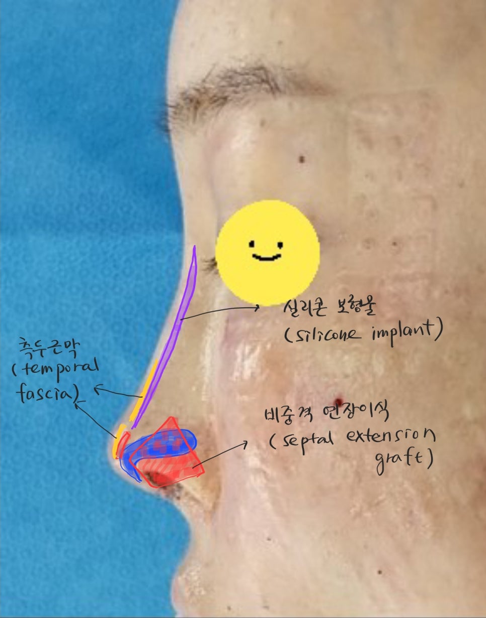 코끝연골이 비치는 경우 중년코재수술 관련 이미지 6