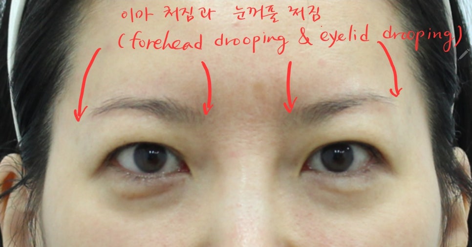 상안검 성형과 이마거상을 함께 했을 때 장점 관련 이미지 2
