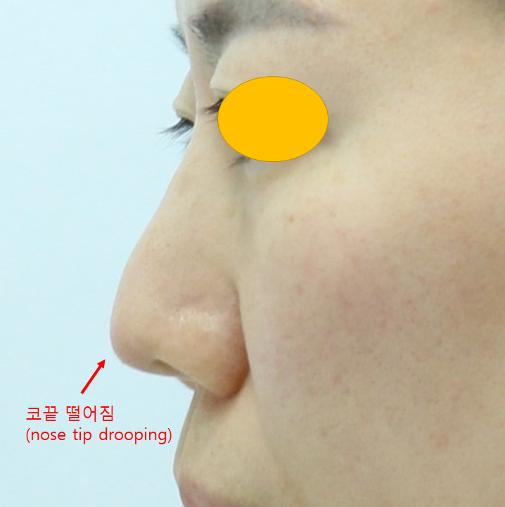 고어텍스 보형물을 자가조직으로 교체하는 코성형 관련 이미지 1