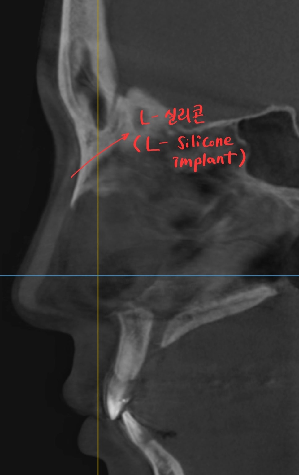 자가늑연골을 이용한 코 재수술 관련 이미지 1