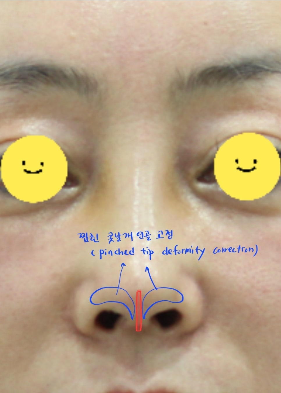 Correction of a Pinched Nose or Indented Nose image 6
