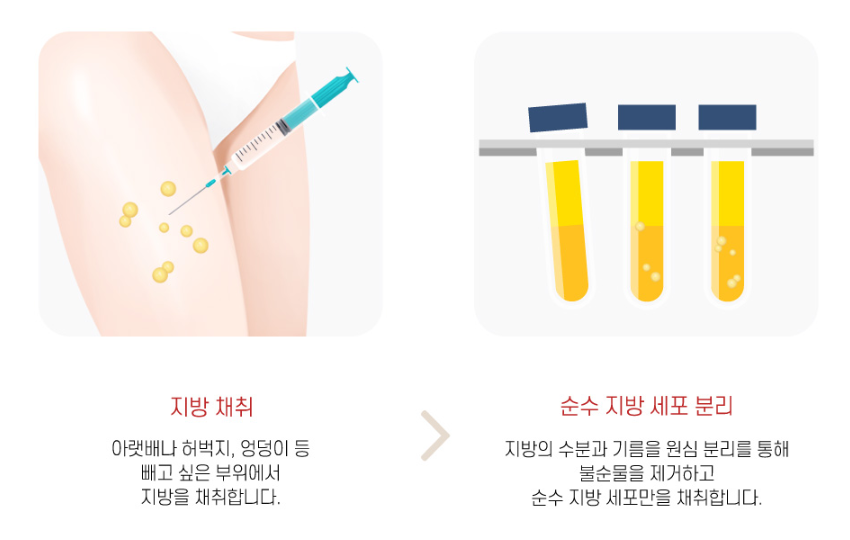 레누바(Renuva)와 줄기세포 지방이식 관련 이미지 6