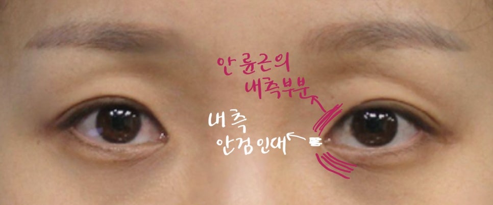 Two-Way Epicanthoplasty for a Cool Semi-Outlook Line image 1