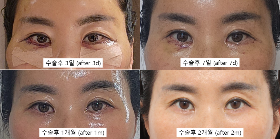 하안검 vs 눈밑지방재배치, 40~50대에서 선택하기 관련 이미지 3