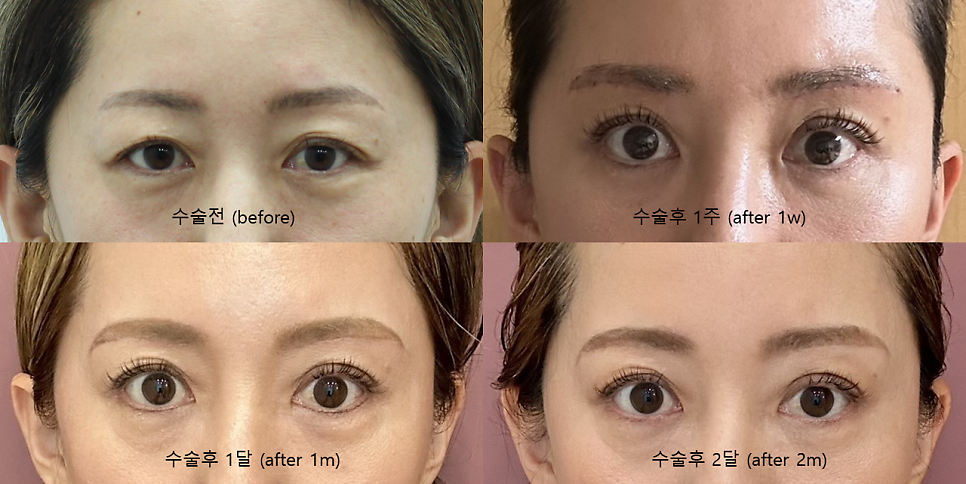 Recovery Process After a Subbrow Lift (Under-Brow Lift) image 4