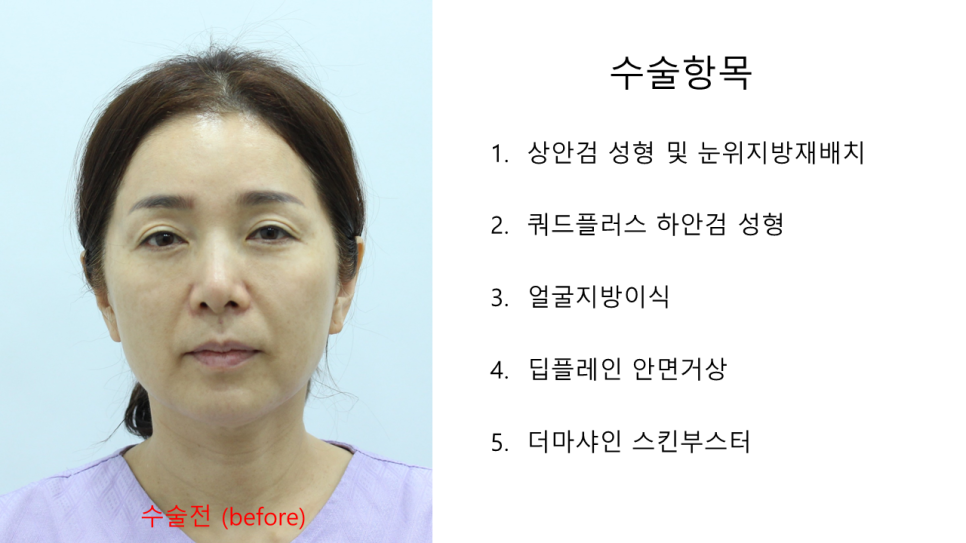 노화의 원인을 교정하는 중년성형 수술 관련 이미지 2