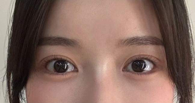 눈 아래부분을 화려하게 만드는 눈성형 관련 이미지 7