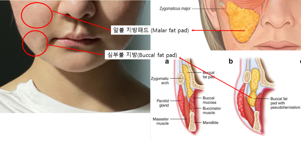 앞볼 지방과 심부볼 지방을 리프팅하는 딥미니거상 관련 이미지 3