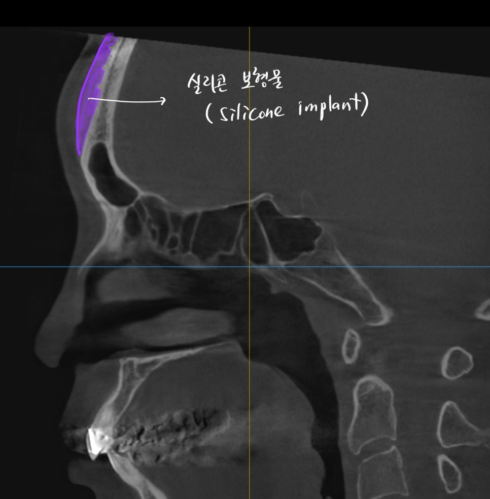내시경을 이용한 최소절개 이마 보형물 제거 관련 이미지 3