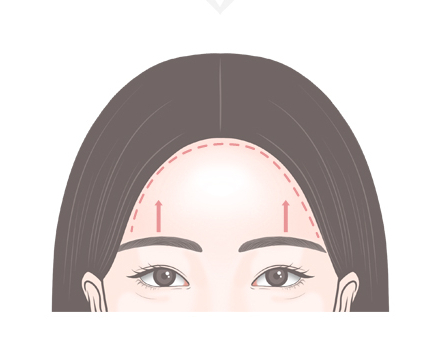 【Garnet Plastic Surgery Dr. Baek Insoo’s Plastic Surgery Column】 Fast Recovery After Pentafix Forehead Lift image 2