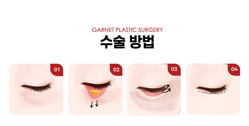 압구정역성형외과에서 알아보는 대표적인 동안성형 종류! 관련 이미지 6