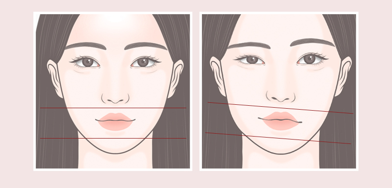 【Garnet Plastic Surgery Director Baek In-soo’s Plastic Surgery Column】 Facial Asymmetry and Crooked Nose Surgery image 4