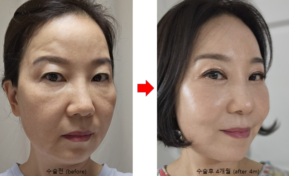 안티에이징 수술의 효과와 유지기간 관련 이미지 4