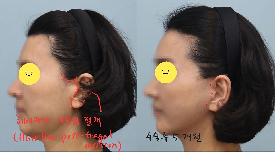 안면거상에서 절개선의 선택방법 관련 이미지 9