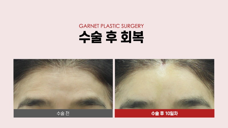 【가넷성형외과 백인수원장 성형칼럼】 50대 여성 이마거상 후 빠른 회복 관련 이미지 5