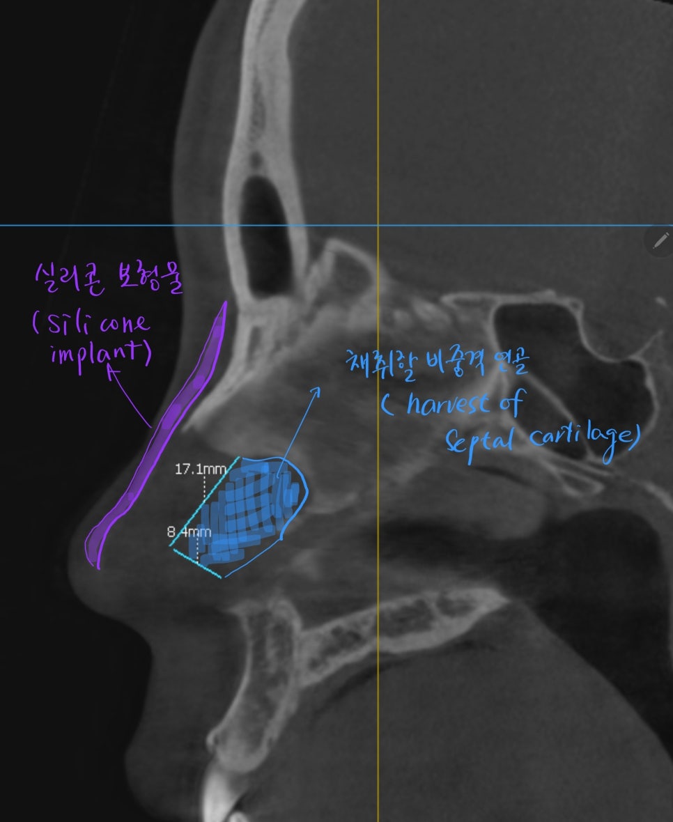 Checking the Size of the Septal Cartilage with a CT Scan Before Revision Nose Surgery image 2