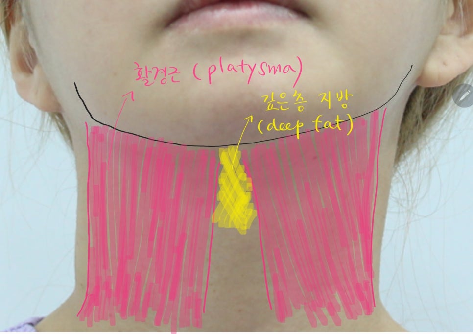 Submental Incision Neck Lift for a Deep Neck Line image 2