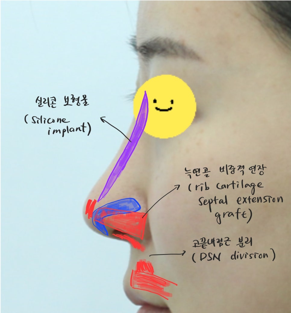 긴코 교정과 비순각 조절을 위한 코끝 리모델링 관련 이미지 6