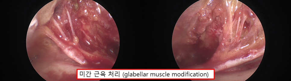 Endoscopic Forehead Lift for a Smooth Forehead image 2