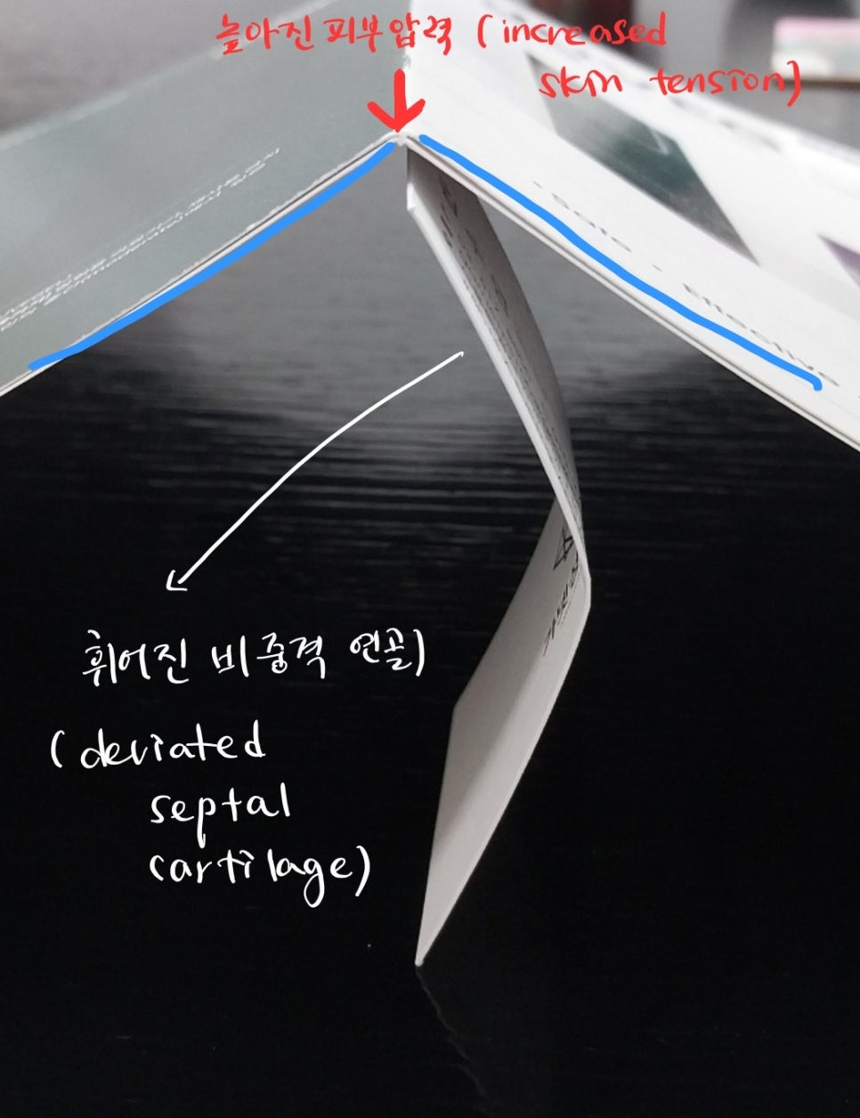 코성형후에 코가 휘었을때의 재수술 관련 이미지 6