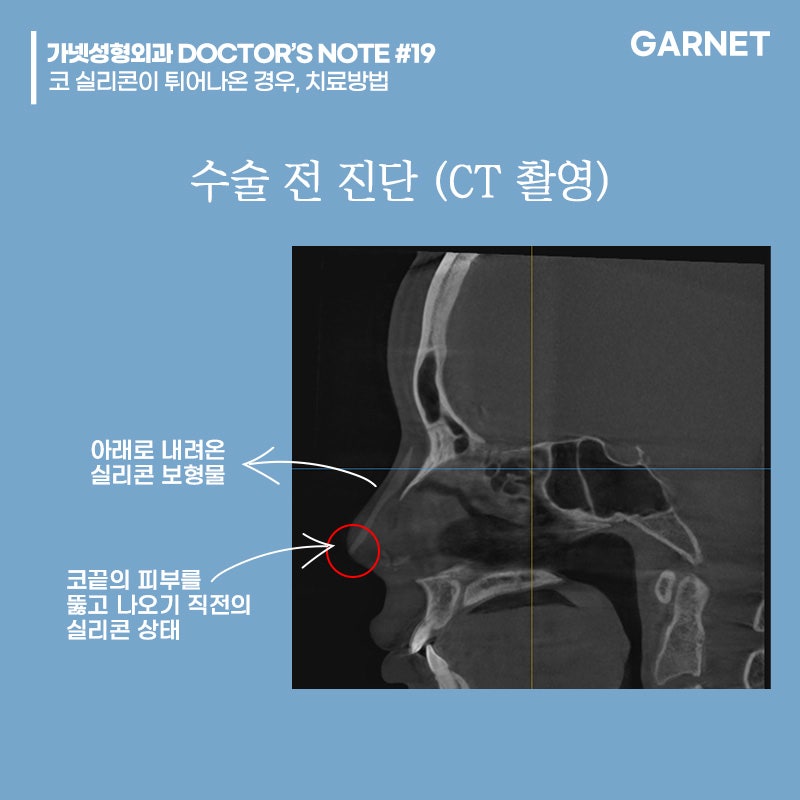 [가넷성형외과 백인수원장 성형칼럼] 코 실리콘이 튀어나온 경우, 치료방법 관련 이미지 3