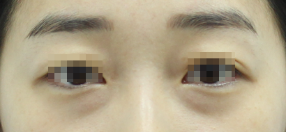 The Surgical Process of Lower Eyelid Fat Repositioning image 1