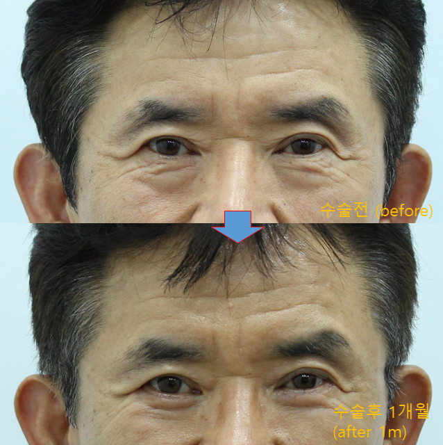 중년 남성 하안검 수술과 표정주름 관련 이미지 4