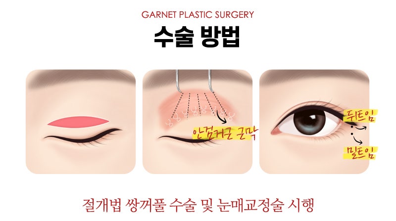 【Garnet Plastic Surgery Director Baek In-soo’s Plastic Surgery Column】 Eye Correction for a Rounder, Kinder Eye Shape image 6