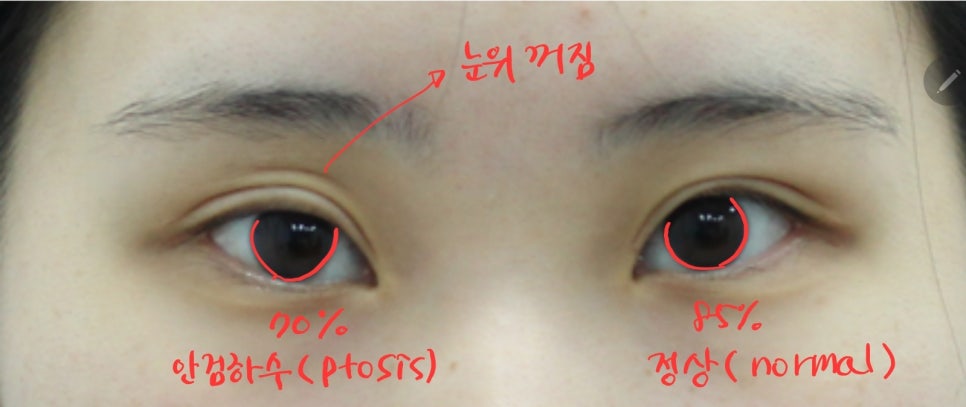 안검하수가 동반된 짝눈의 쌍꺼풀 재수술 관련 이미지 3