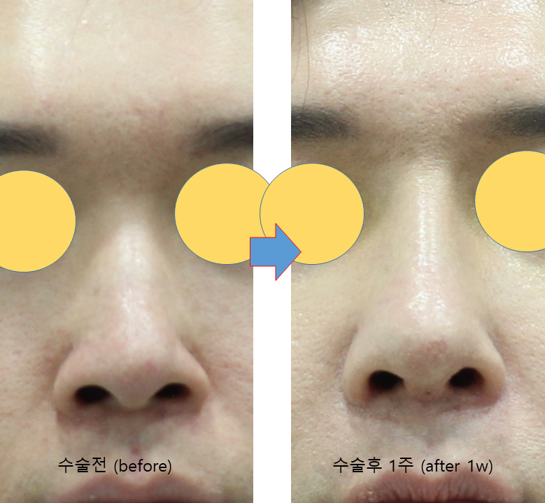 Male Rhinoplasty Performed Alongside Septoplasty image 4