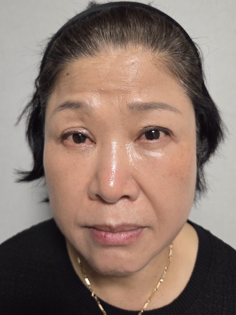 상안검 수술 후에도 눈이 불편하다면? &ndash; 눈 재수술과 이마거상을 함께 하는 이유 관련 이미지 3
