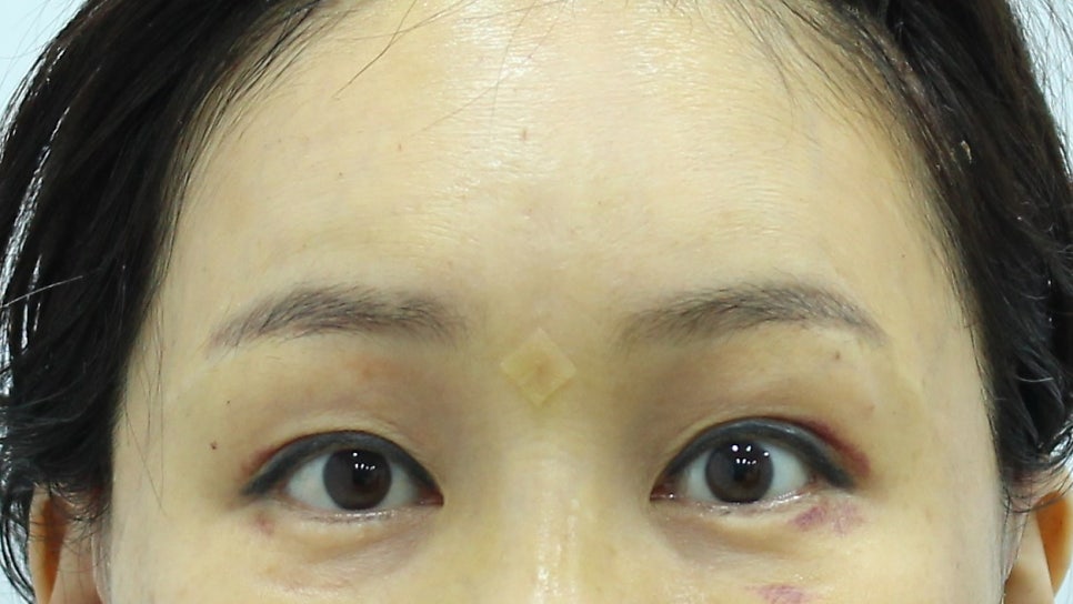 Forehead Lift to Correct Eyebrow Asymmetry image 10