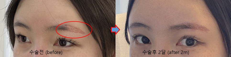 Resolving Eyebrow Semi-Permanent Dissatisfaction and Drooping Eyelids at the Same Time image 1