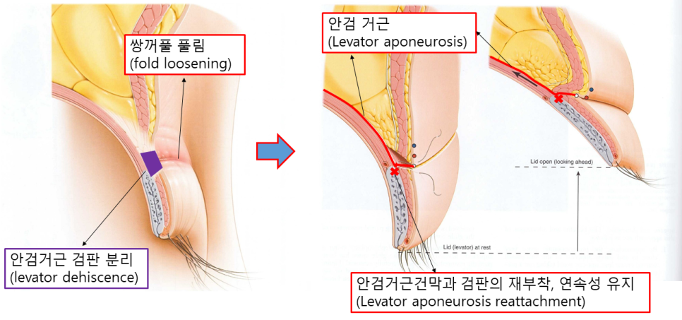 쌍꺼풀이 풀리고 눈두덩이가 꺼졌다면? 재수술로 살펴본 원인 관련 이미지 3