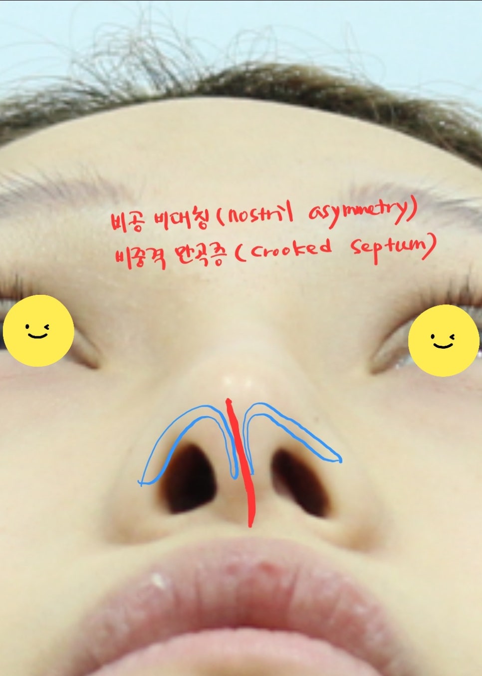 Rib Cartilage Rhinoplasty for a Deviated Saddle Nose image 1