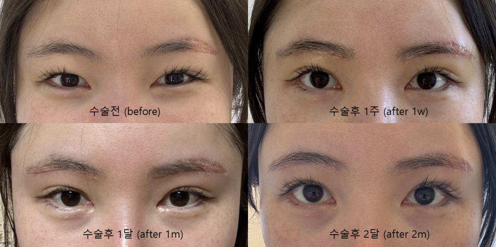 Resolving Eyebrow Semi-Permanent Dissatisfaction and Drooping Eyelids at the Same Time image 2