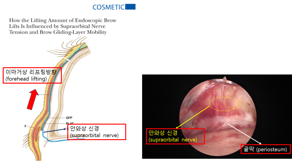 Surgical Methods That Reduce Nerve Symptoms in Endoscopic Brow Lift image 2