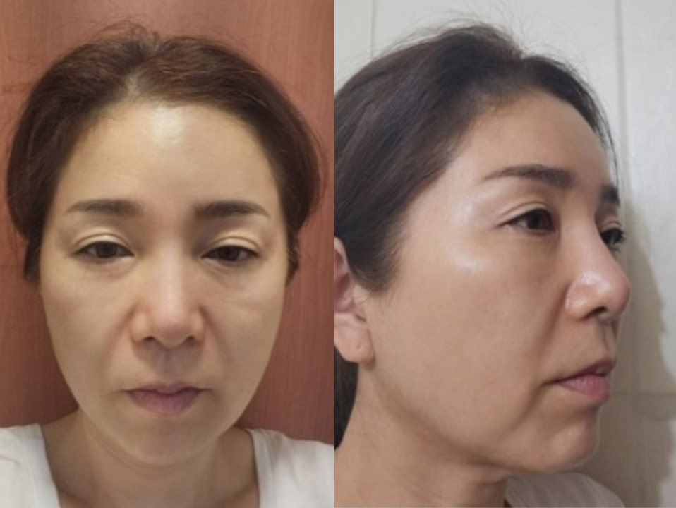얼굴의 지방층 변화와 중년지방이식 관련 이미지 5