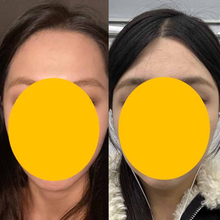 Forehead Reduction Surgery to Naturally Lower the Hairline image 6