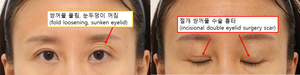 쌍꺼풀이 풀리고 눈두덩이가 꺼졌다면? 재수술로 살펴본 원인 관련 이미지 1