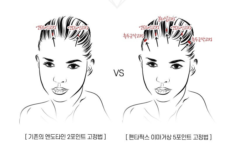 【Garnet Plastic Surgery Dr. Baek Insoo’s Plastic Surgery Column】 Fast Recovery After Pentafix Forehead Lift image 6