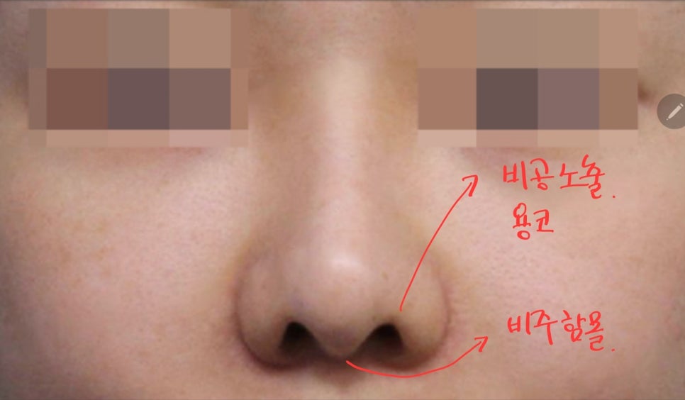 Lengthening Revision Rhinoplasty for a Short, Upturned Nose image 1