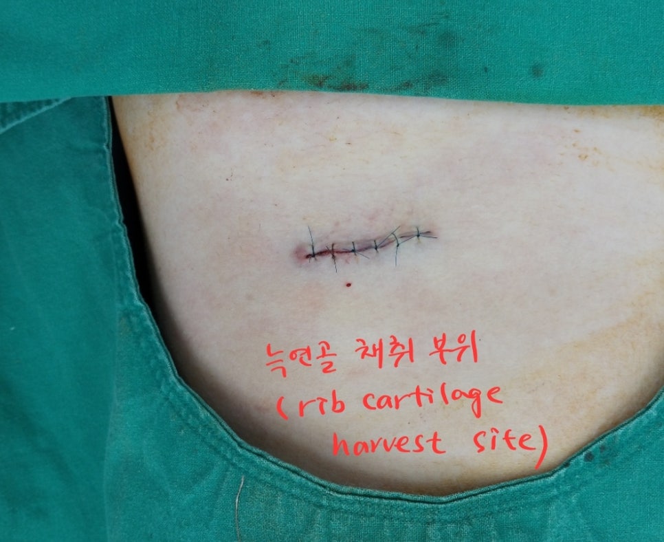 코성형후에 코가 휘었을때의 재수술 관련 이미지 9