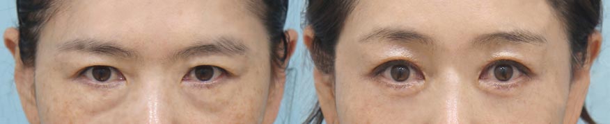Choosing a Surgical Method for Upper Eyelid Skin Sagging image 8