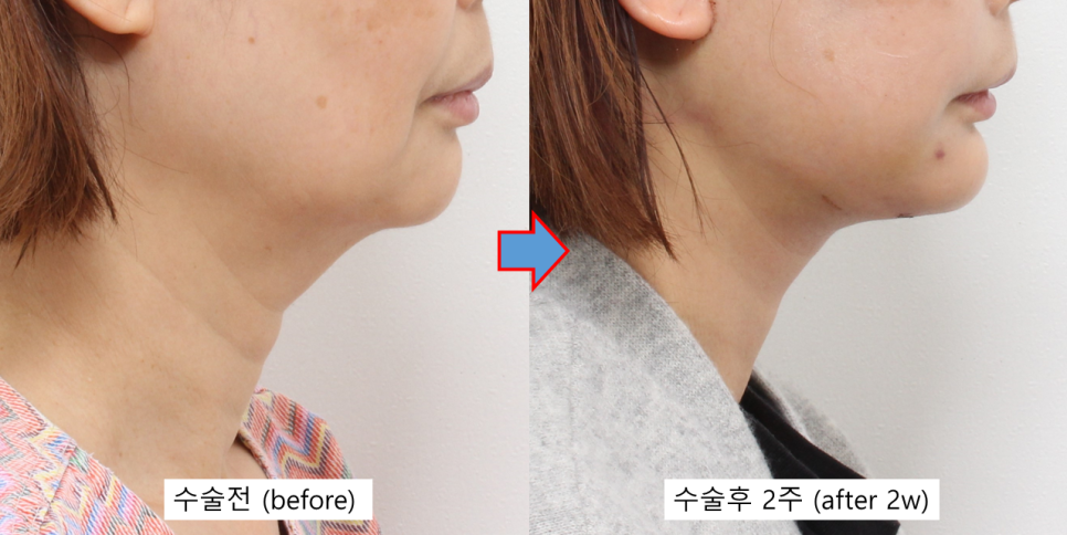 턱끝성형과 함께하는 펠리컨수술 관련 이미지 5