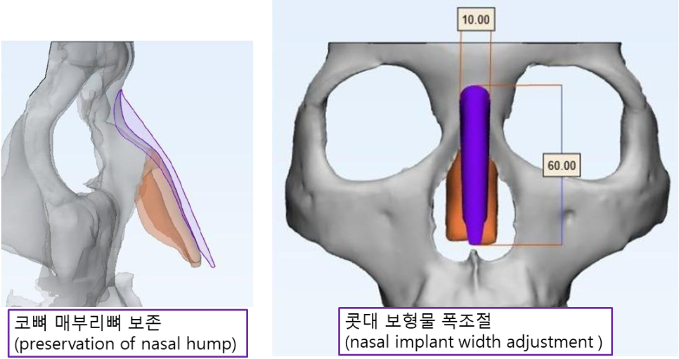 코뼈를 깎지 않는 코성형? 3D CT 맞춤형 코보형물 관련 이미지 2