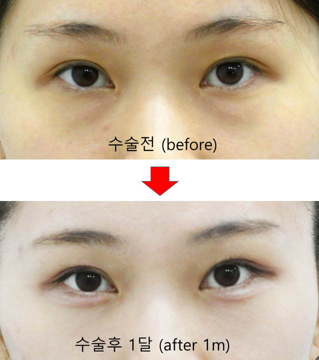 Under-Eye Fat Repositioning and Aegyo-Sal Fat Grafting image 7