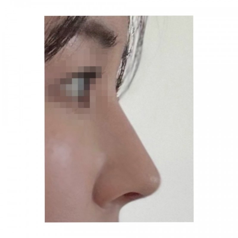 자연스러운 변화를 위한 무보형물 코성형 관련 이미지 6